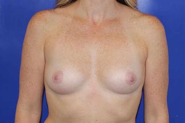 Before Breast Augmentation Female Patient Front Angle View Case 2211