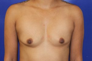 Before Breast Augmentation Female Patient Front Angle View Case 2225