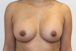 After Breast Augmentation Female Patient Front Angle View Case 2225