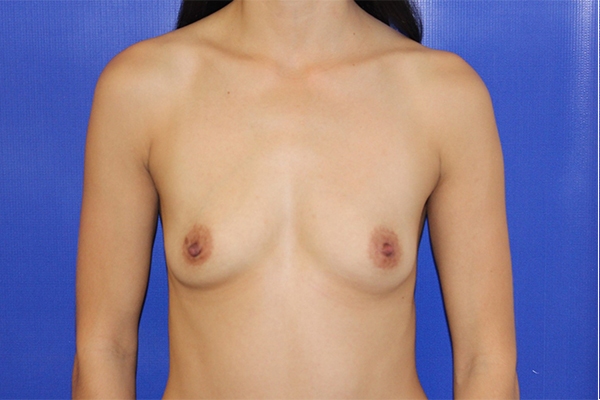 Before Breast Augmentation Female Patient Front Angle View Case 2232