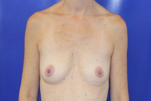Before Breast Augmentation Female Patient Front Angle View Case 2239