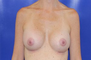 After Breast Augmentation Female Patient Front Angle View Case 2239