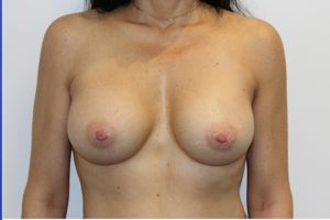 After Breast Augmentation Female Patient Front Angle View Case 2247