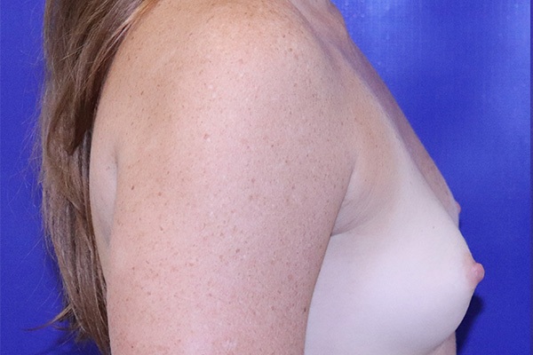 Before Breast Augmentation Female Patient Side Angle View Case 2254