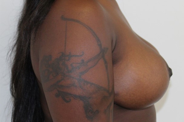 After Breast Reduction Female Patient Side Angle View Case 2331