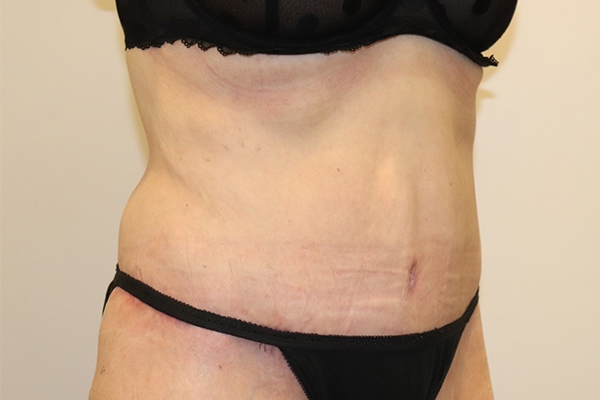After Circumferential Abdominoplasty Female Patient Diagonal Angle View Case 2374