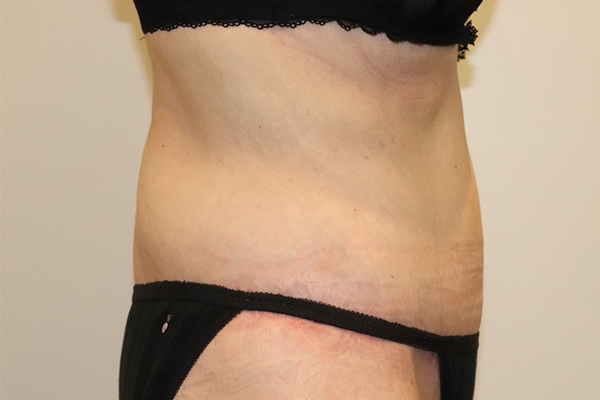 After Circumferential Abdominoplasty Female Patient Side Angle View Case 2374