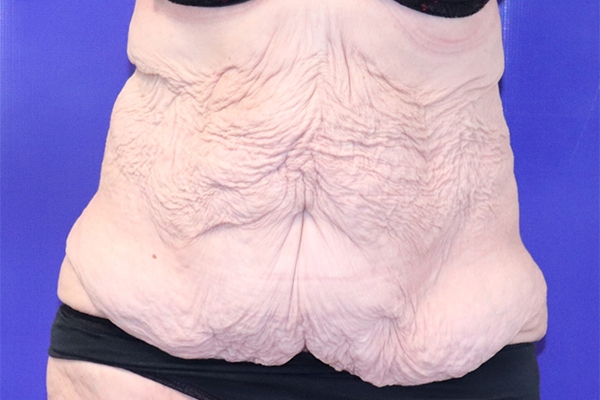 Before Circumferential Abdominoplasty Female Patient Front Angle View Case 2374