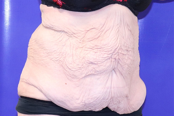 Before Circumferential Abdominoplasty Female Patient Diagonal Angle View Case 2374