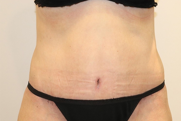 After Circumferential Abdominoplasty Female Patient Front Angle View Case 2374