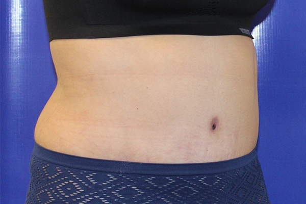 After Circumferential Abdominoplasty Female Patient Diagonal Angle View Case 2381