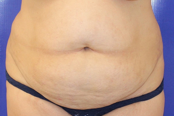 Before Circumferential Abdominoplasty Female Patient Front Angle View Case 2381