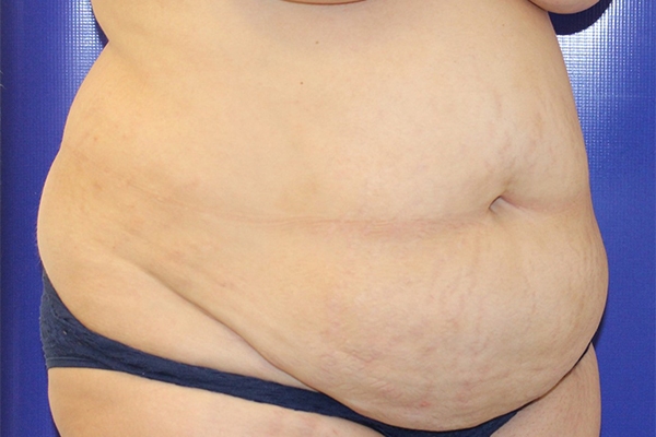 Before Circumferential Abdominoplasty Female Patient Diagonal Angle View Case 2381
