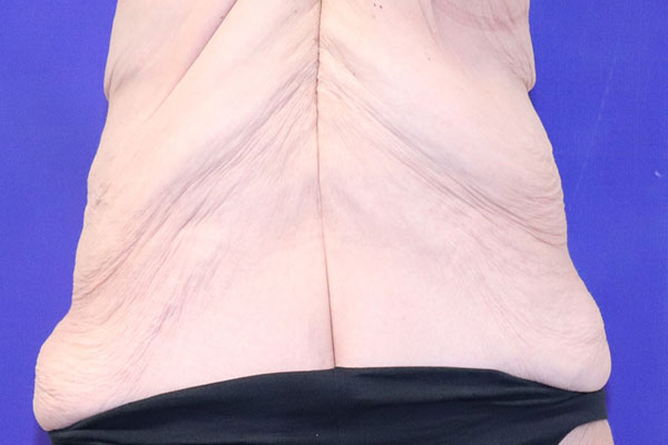 Before Circumferential Abdominoplasty Female Patient Back Angle View Case 2374