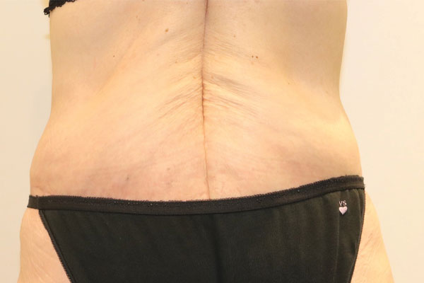 After Circumferential Abdominoplasty Female Patient Back Angle View Case 2374