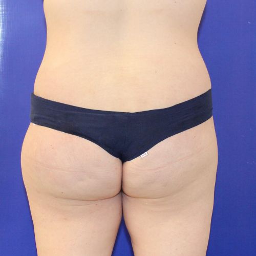 after halo lift female patient back view case 2464