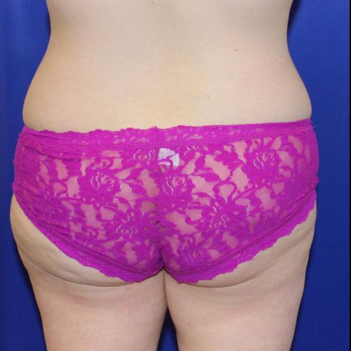 before halo lift female patient back view case 2464