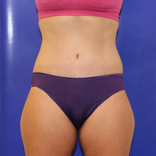 after halo lift female patient front view case 2473