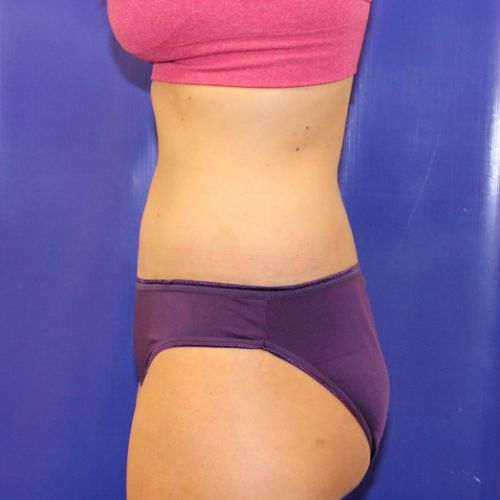 after halo lift female patient side view case 2473