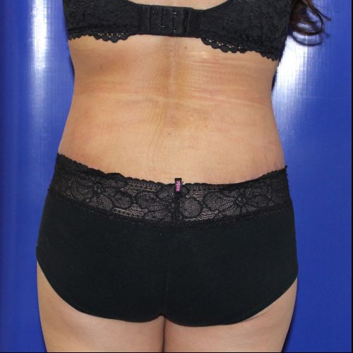 after halo lift female patient back view case 2482