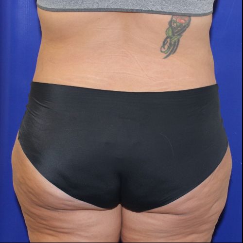 before halo lift female patient back view case 2500