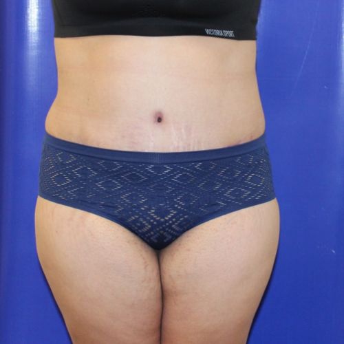 after halo lift female patient front view case 2509