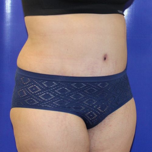 after halo lift female patient front angle view case 2509