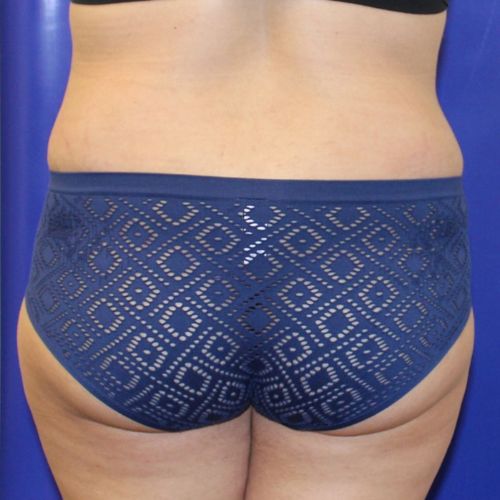 after halo lift female patient back view case 2509