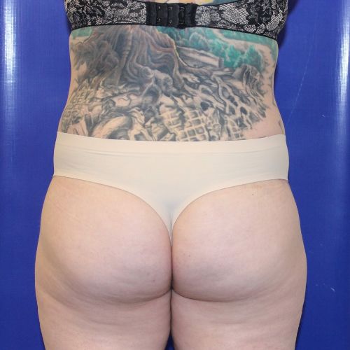 after halo lift female patient back view case 2518