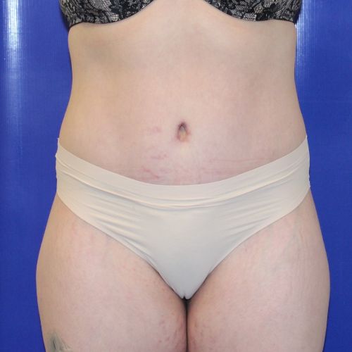 after halo lift female patient front view case 2518