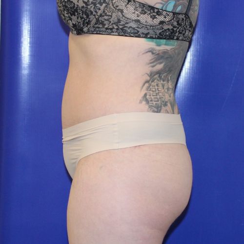 after halo lift female patient side view case 2518