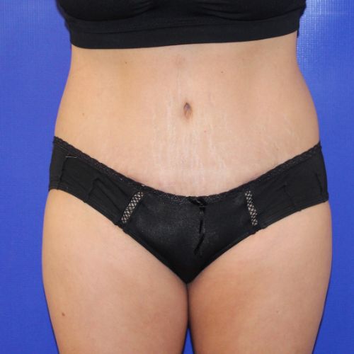 after halo lift female patient front view case 2527