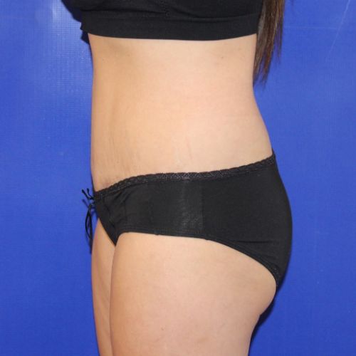 After Halo Lift Female Patient Side Angle View Case 2527