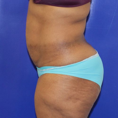 before halo lift female patient side view case 2536