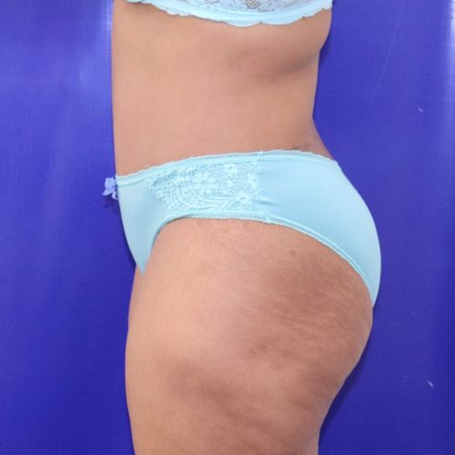 after halo lift female patient side view case 2536