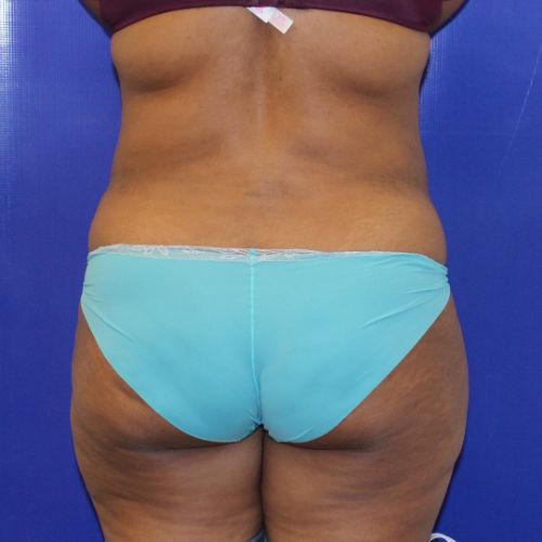 before halo lift female patient back view case 2536