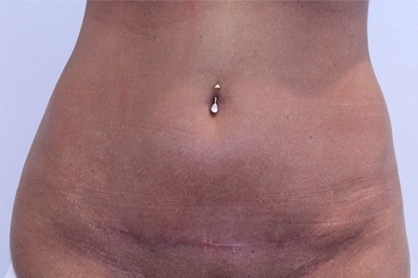 After Mini Tummy Tuck Female Patient Front Angle View Case 2270