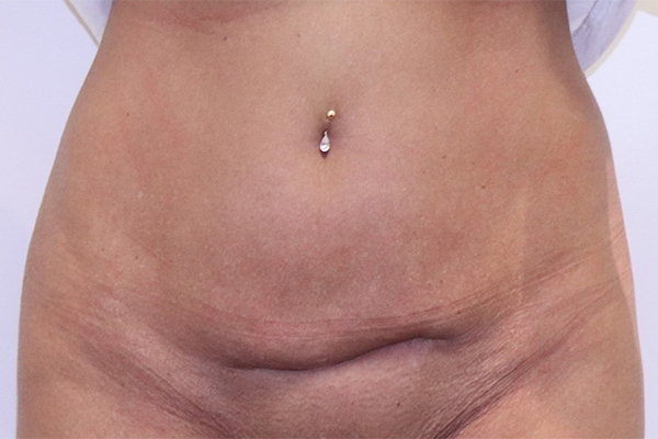 Before Mini Tummy Tuck Female Patient Front Angle View Case 2270