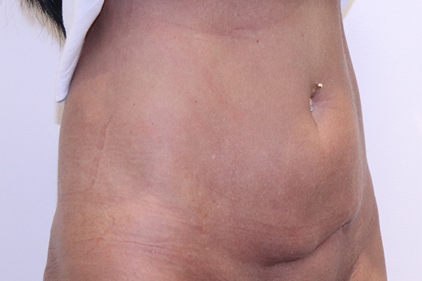 Before Mini Tummy Tuck Female Patient Diagonal Angle View Case 2270