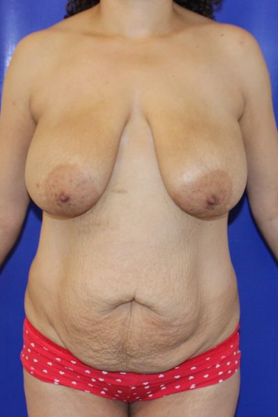 before mommy makeover female patient front view case 2436