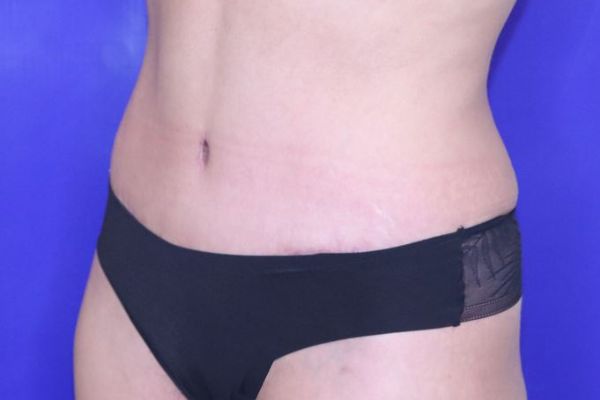 after tummy tuck female patient front angle view case 2443