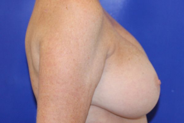 Before Breast Revision Female Patient Side Angle View Case 2847