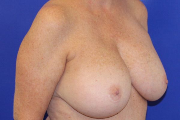Before Breast Revision Female Patient Diagonal Angle View Case 2847