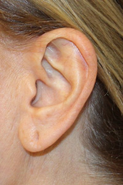 Before Earlobe Reduction Case 2854