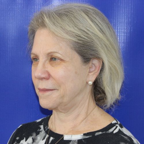 Before Face and Neck Lift Female Patient Diagonal Angle View Case 2874