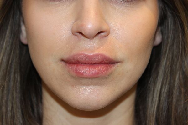 After Filler Female Patient Front Angle View Case 2857