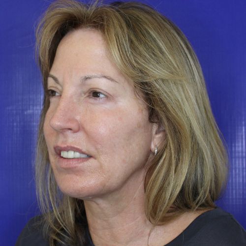 After Filler Female Patient Diagonal Angle View Case 2860