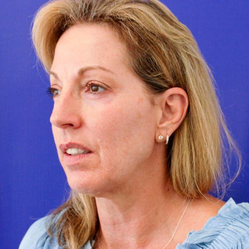 Before Filler Female Patient Diagonal Angle View Case 2860