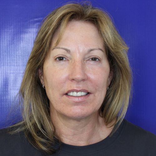 After Filler Female Patient Front Angle View Case 2860