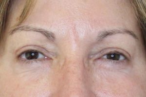 After Filler Female Patient Front Angle View Case 2868